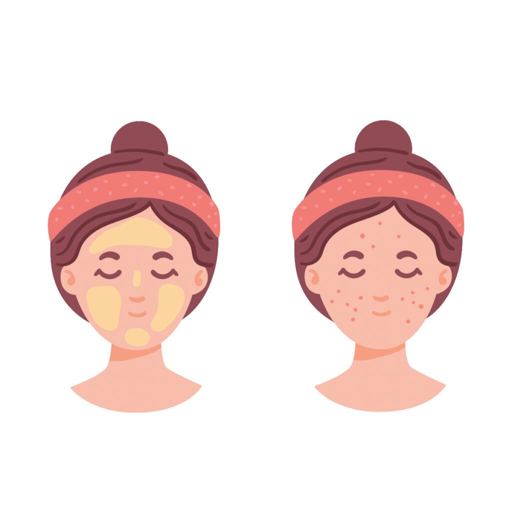 Oily, Acne-Prone Skin